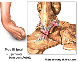 Mechanics of an Ankle Sprain